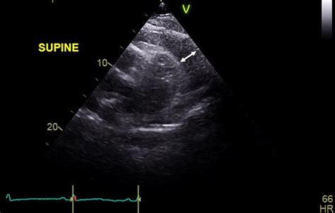 Should A Large Pericardial Effusion Be Drained To Drain Or Not To