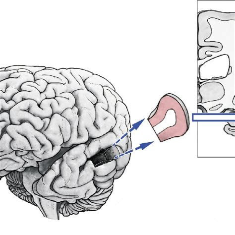 Schematic Drawing Of The Dissected Human Brain Tissue Probes Position