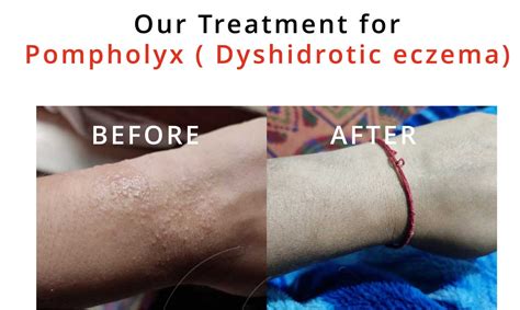 Our Treatment For Pompholyx Or Dyshidrotic Eczema Blister