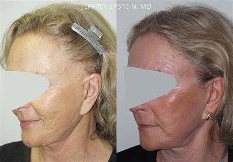 Repair Facelift Scarring Before And After Photos Foundation For Hair