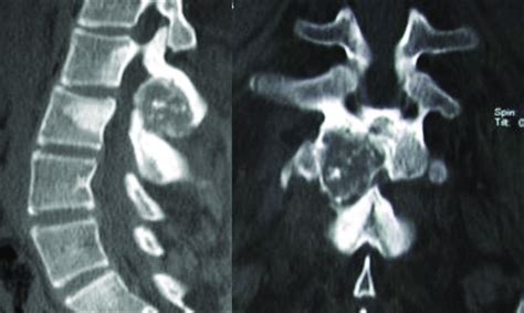 Osteoblastoma Of L2 Ct Scan Shows An Expansive Osteolytic Lesion Of