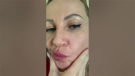 My Russian Lips Hydraulic Acid 3 Weeks After Youtube