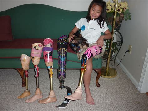 Amputee Model Prosthetic Leg Amputee Lady