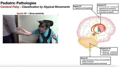 Cerebral Palsy Overview 🧠 Introduction And Classifications Youtube