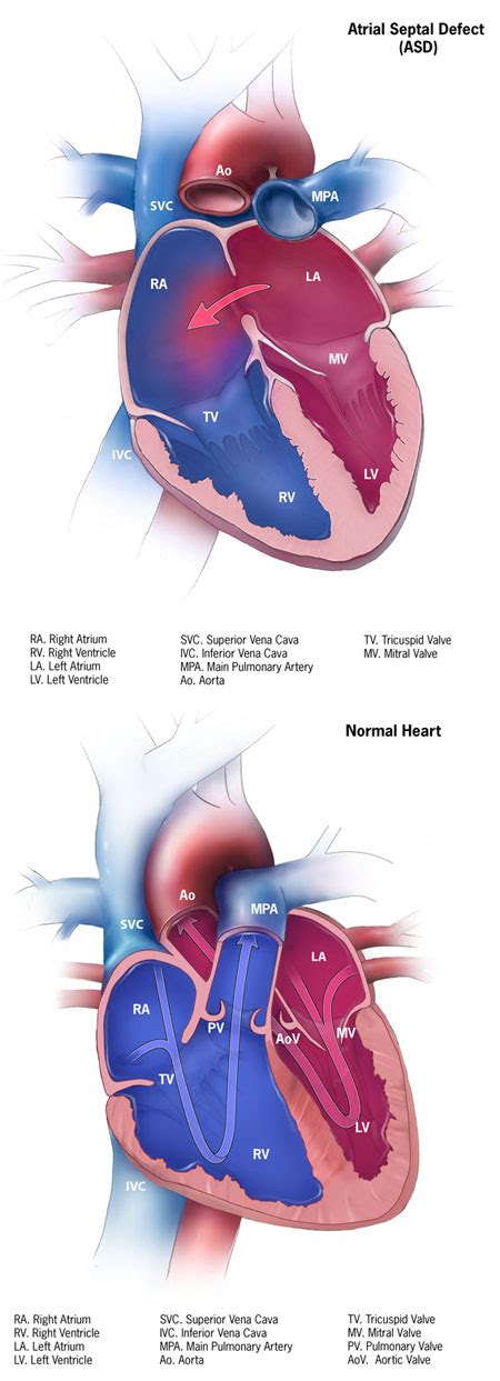 Cdc Congenital Heart Defects Atrial Septal Defect