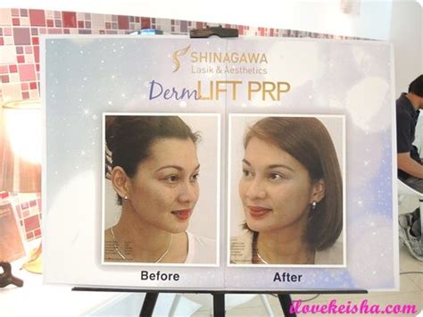 Shinagawa Dermlift Prp Lasik Bb Cream Polaroid Film Aesthetic Blog