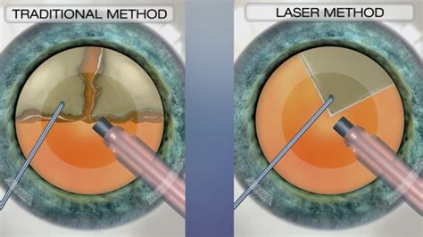 Cataract Treatment Options Lasik Cataract Centre
