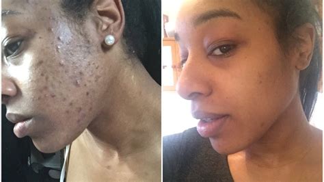 How To Get Rid Of Acne And How To Fade Scars Youtube
