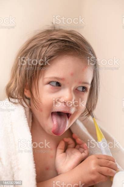 Funny Girl With Chicken Pox Grimace Tongueout With Thermometer Stock