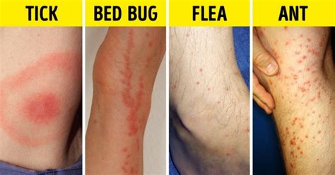Bed Bug Vs Flea Bites Photos Surematrixservices