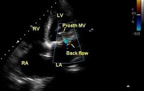 Prosthetic Mitral Valve Echocardiogram