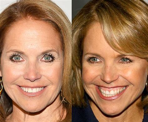 katie couric plastic surgery facelift botox injection