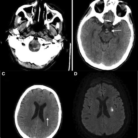 Initial Non Contrast Head Computed Tomography Scan Shows Subarachnoid