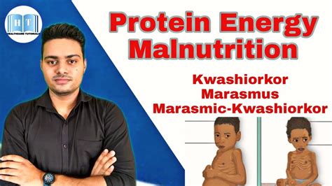 Protein Energy Malnutrition Kwashiorkor Vs Marasmus Youtube