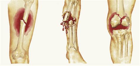 Pain Management Options For Bone Fractures Guardian Liberty Voice
