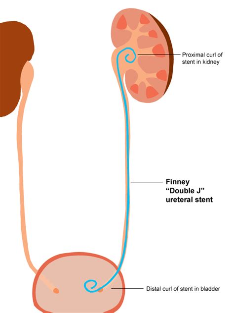 A Brief History Of Ureteral Stents