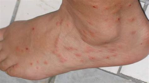 What Do Flea Bites Look Like On Humans With Symptoms Manvspest