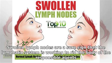 10 Home Remedies To Treat Swollen Lymph Nodes Naturally Youtube