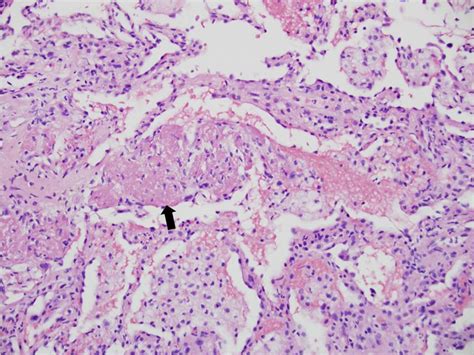 Case Transbronchial Biopsy Shows Lung Parenchyma With Intra Alveolar