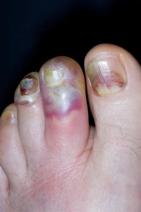 Cellulitis Of The Toes Photograph By Dr P Marazziscience Photo Library