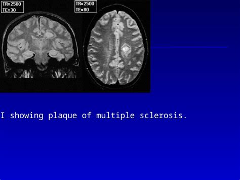 Ppt Mri Showing Plaque Of Multiple Sclerosis Left Coronal Section