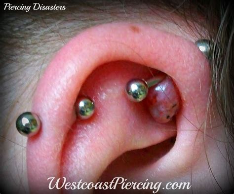 Westcoast Piercing And Ink Large Keloid On Ear