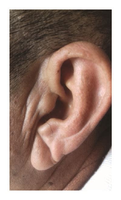 Diagonal Earlobe Crease In An Atahualpa Resident Download Scientific