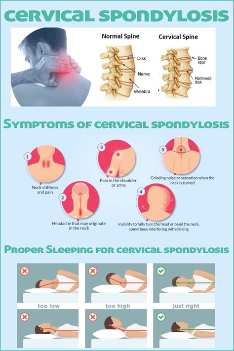 Cervical Spondylolisthesis Symptoms Causes Treatment