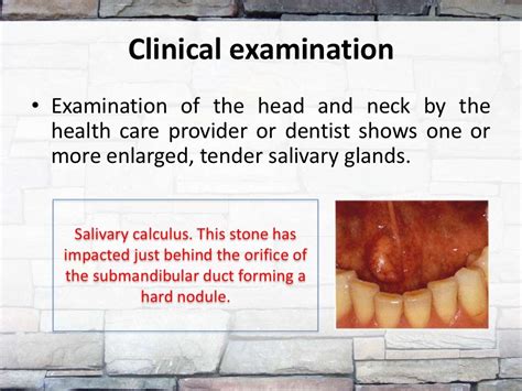 Diagnosis Of Salivary Stones