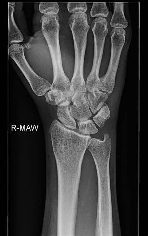 Orthodx Isolated Ulnar Styloid Fracture Clinical Advisor