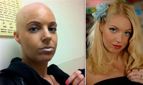 Hollie Stevens Bald Headed Porn Star Battling Cancer At Age 30 Daily