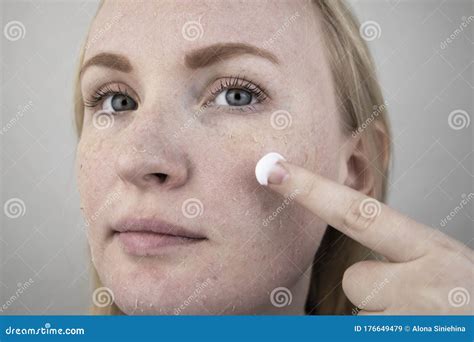 A Woman Examines Dry Skin On Her Face Peeling Coarsening Discomfort