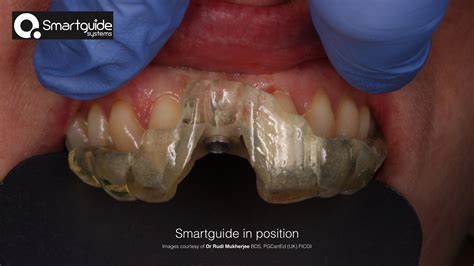 The Smart Guide System Dental Implants Chula Vista