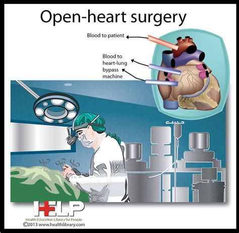Open Heart Surgery Open Heart Surgery Heart Surgery Medical Careers
