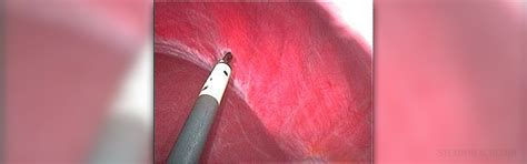 Lernen sie die übersetzung für 'endometriosis' in leos englisch ⇔ deutsch wörterbuch. Endometriosis and fertility facts | Women's Health ...