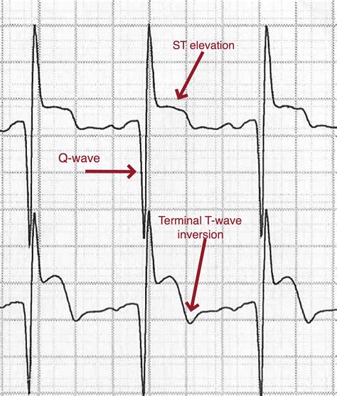 Emergency Medicine Educationpost Stemi Ecg Mirror Image