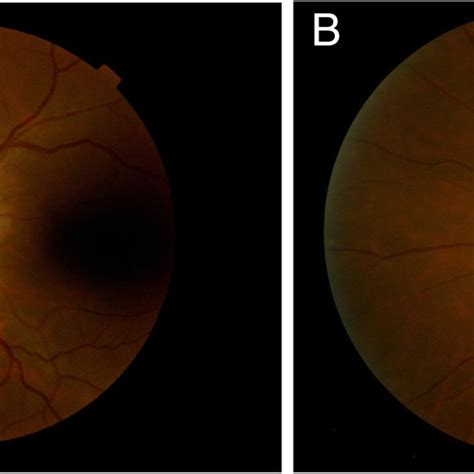 Optic Disc Edema Before And After Radiation Therapy A Funduscopic