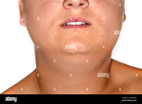 Mumps Close Up Of The Swollen Face Of A 14 Year Old Male Patient With