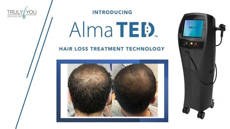 Alma Ted Hair Loss Treatment Technology Youtube
