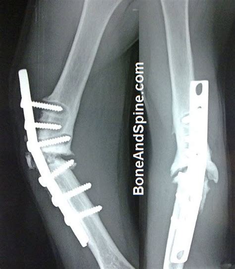 Nonunion Delayed Union And Malunion Complications Of Fracture