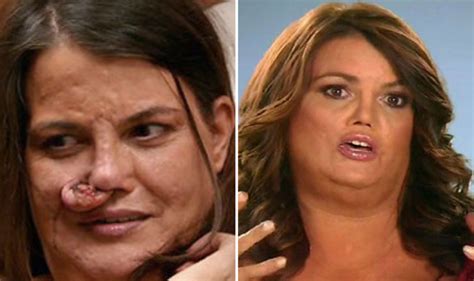 The Most Shocking Botched Plastic Surgery Transformations