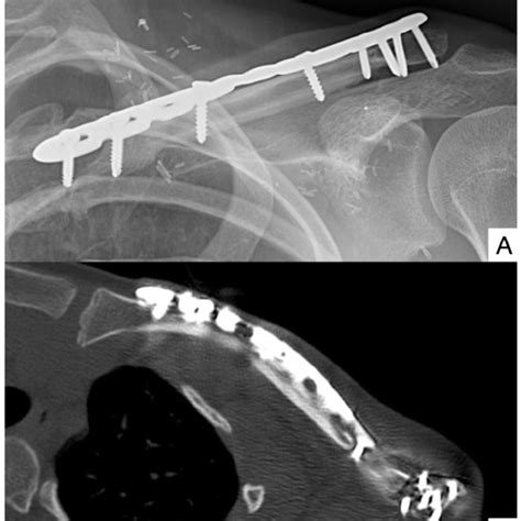 A Image Showing The Osteocutaneous Free Fibula Flap B Image