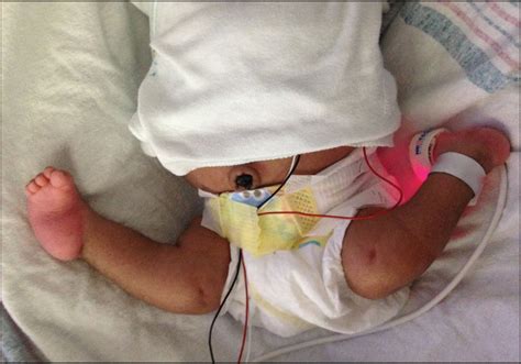 A Neonate With Deformities Of The Bilateral Lower Extremities And Bowel