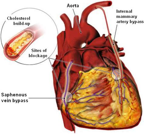 Illustration Of Coronary Arterial Bypass Grafting A Saphenous Vein