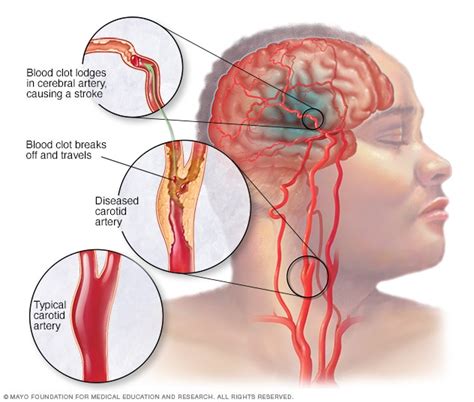 Accidente cerebrovascular Síntomas y causas Mayo Clinic