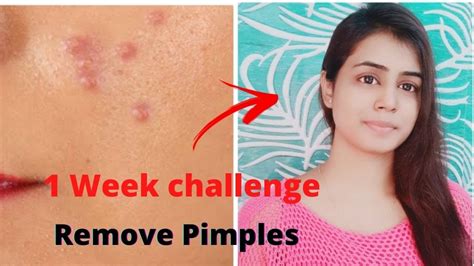 How To Remove Pimples Acne Pimple Marks Pimple Ko Kaise Hataye