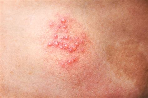 Woman Leg Skin Background With Rash From Herpes Zoster Or Shingles