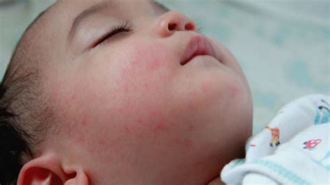 Dengue Rashes Smart Parenting