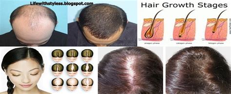 Hair Fall And Baldness Check Out How To Make Hair Re Grow In Bald