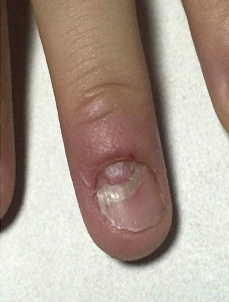 Deformed Nails Causes Nail Ftempo